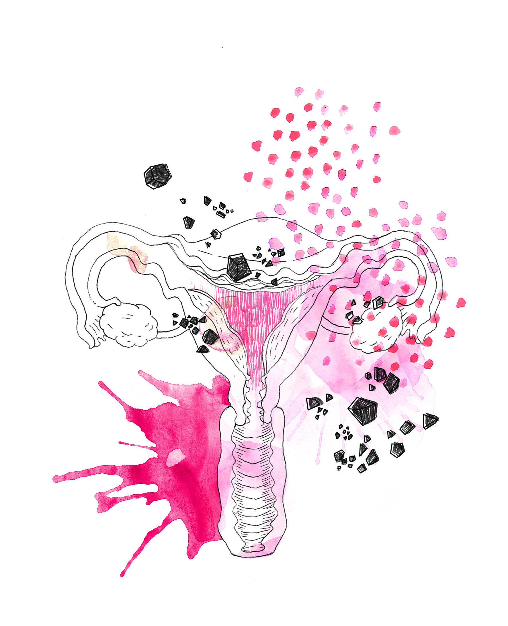 Des barbelés dans le ventre : l’endométriose, un cancer qui ne tue pas